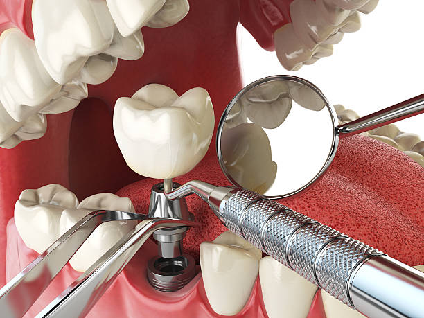 Best Emergency Dentist for Lost Fillings or Crowns in Chatmoss, VA